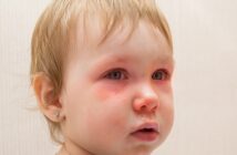 Augenkrankheiten bei Kindern: Rechtzeitige Diagnose sorgt für eine gesunde Entwicklung